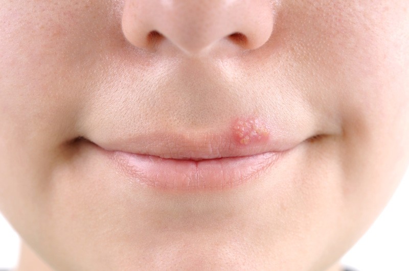 Effective for Home Remedies For Cold Sores