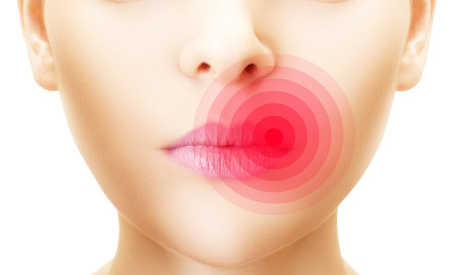 How Long Do Cold Sores Last? (5 Stages Cold Sore)