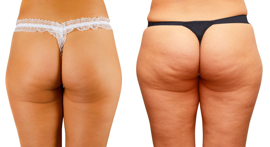 Truth About Cellulite Review - The Accurate And Unbiased Version