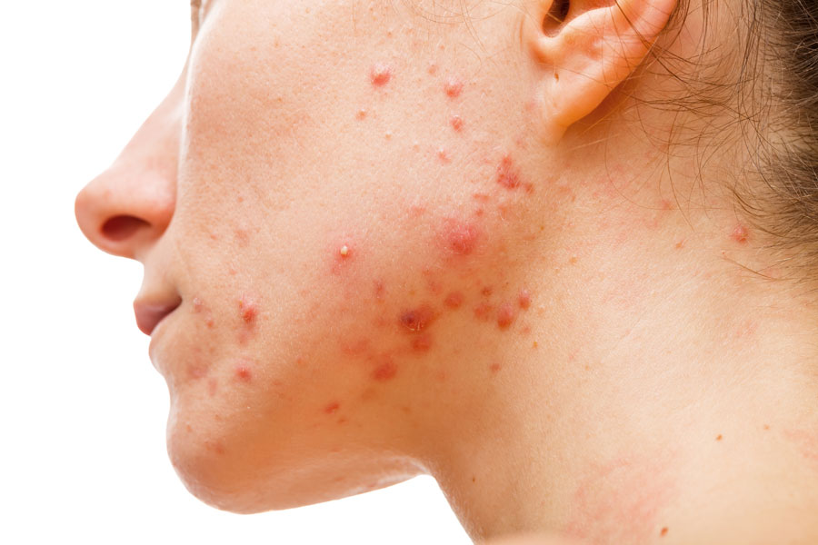 What is Cystic Acne? - The Effects Of Cystic Acne