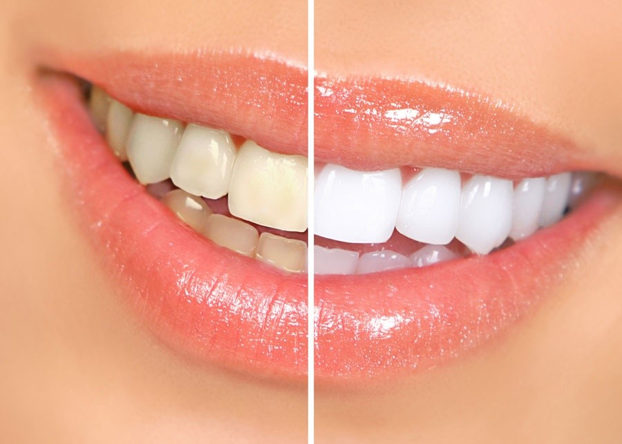 How To Whiten Teeth Fast? Everybody Wants To Know