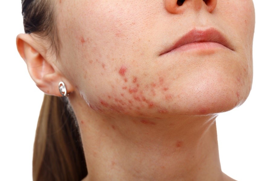 How to Get Rid of Cystic Acne on Chin